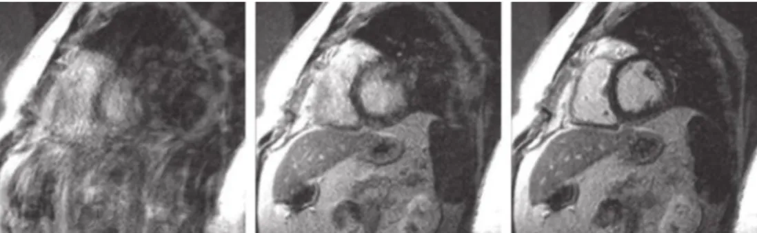 Figure 2.9: Image DE-MRI showing: (a) ghosting artefacts of the overall chest area due to deficient breath holding (b) ghosting artefacts of the heart itself due to poor cardiac gating (c) no ghosting artefacts due to acquisition with correct breath hold a