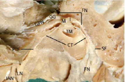 Figure 2.5: Dissection of the chorda tympani nerve from facial nerve, passing through the tympanic cavity and joining the lingual nerve