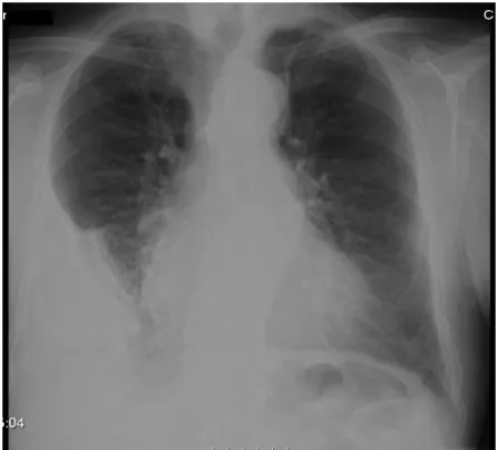 Figura 1 – Radiografia do tórax à admissão  