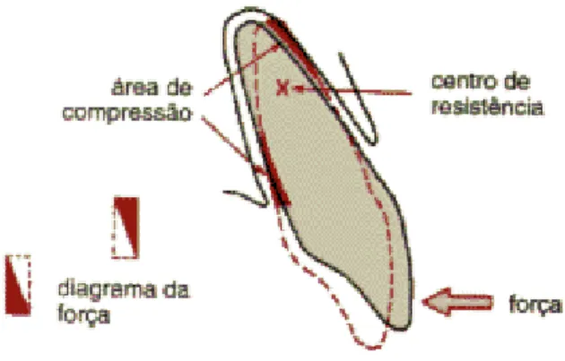 Fig 1 – Aplicação de uma força simples à coroa de um dente. 