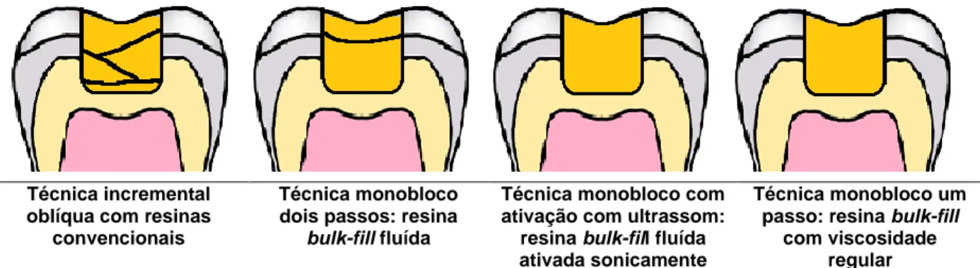 Figura 1 Ilustração da aplicação de resinas convencionais pela técnica incremental oblíqua e da  aplicação das três variedades de resinas bulk-fill