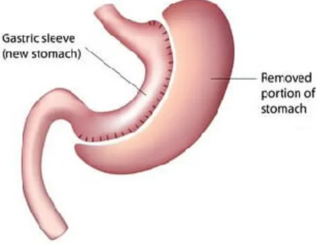 Ilustração 2 - Esquematização do LSG  Fonte: (Bariatric Surgery Source, 2018) 