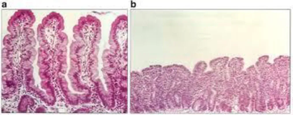 Figura  1-  Mucosa  intestinal  de  dois  indivíduos,  mucosa  de  um  indivíduo  saudável  (a)  e  mucosa  de  um  doente celíaco (b)