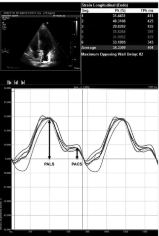 Fig. 1 Velocity vectors and corresponding longitudinal strain curves in six left atrial segments in the apical four-chamber view