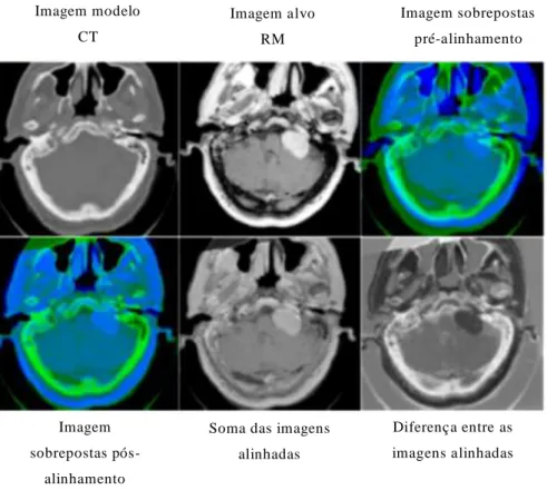 Figura 3.2 – Exemplo de um alinhamento de im agens de d iferentes modalidades (C T/RM) (adaptado de (Oliveira and Tavares  2011a ) )