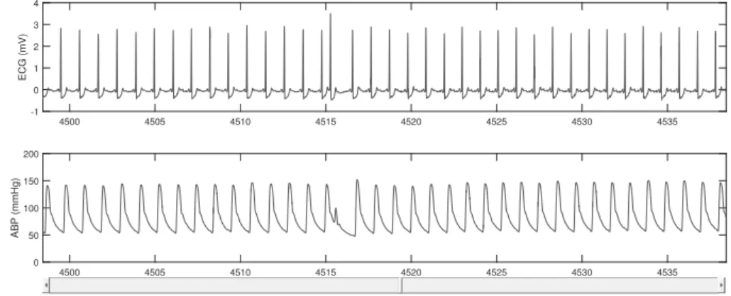 Figura 1.7: Batimento ectópico nas séries ECG e ABP. Mesmo paciente considerado na Figura 1.6