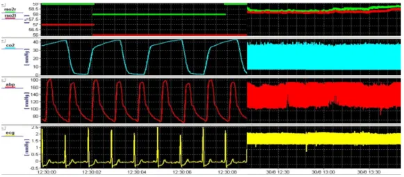 Figura 2.2: Monitorização de um paciente usando o software ICM  O. A gura apresenta uma escala R