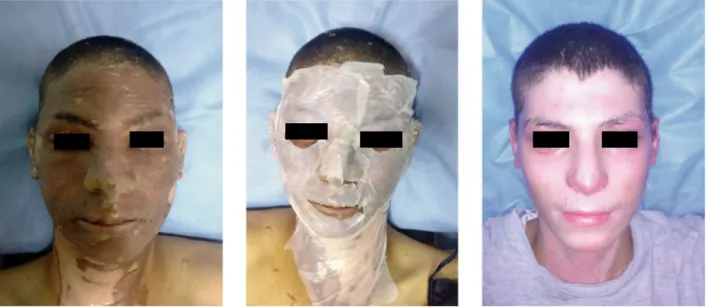 Fig. 7. Time evolution of a facial burn wound during 28 days. On the left, before cleaning; on the middle, with BC sheets applied; and on the right, healed wound after the 28 days