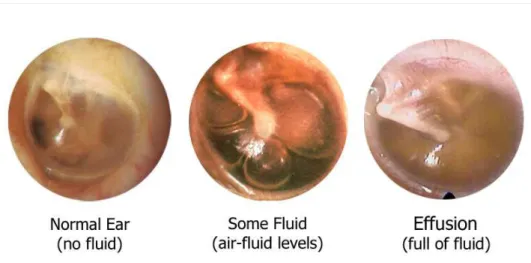 Figura 1 - Imagens otoscópicas do ouvido médio em três condições diferentes 