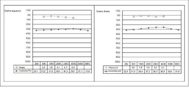 Figura 3 - Exemplo de um audiograma tonal simples de uma criança com OMD 