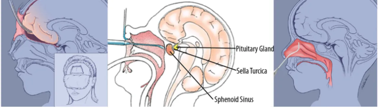 Figure 2.1: Three different ways of removing pituitary tumours in humans. Transcranial (left), transseptal- transseptal-transsphenoidal (middle) and transnasal-transseptal-transsphenoidal (right) surgical routes (Arkenbout, 2012).