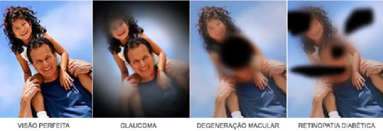 fig 19 – Efeito visual de doenças degenerativas oculares associadas ao envelhecimento