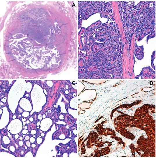Figure 2. Histological observation with hematoxylin-eosin staining of cribriform-morular papillary thyroid carcinoma (thyroidectomy specimen) at (A)  magnification, x40, (B) with solid and cribriform areas at magnification, x100 and (C) magnification, x400