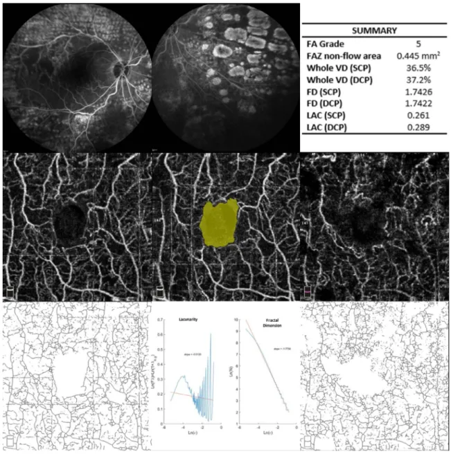 Figure 2. Multimodal imaging in an 81-year-old patient with CRVO (BCVA: 20/40). FA (first line) shows macular perfusion abnormalities and severe nonperfused peripheral area (grade 5) and retinal photocoagulation LASER scars