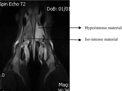 Figure 9 – Hyperintense and iso-intense material in the nasal cavity on a T 2 W image 