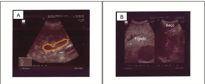 Figura  14 –  A)  Ecografia  abdominal  de  um  canídeo,  Chow-Chow,  com  10  anos  de  idade,  onde  foi  evidenciado  um  aumento  da  glândula  adrenal  esquerda