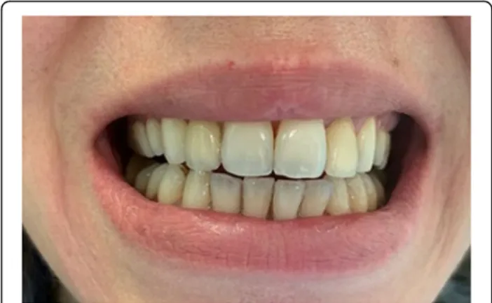 Fig. 1 Greyish discoloration of teeth