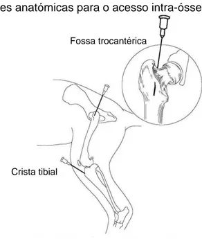 Figura 1 – Localizações anatómicas para o acesso intra-ósseo 