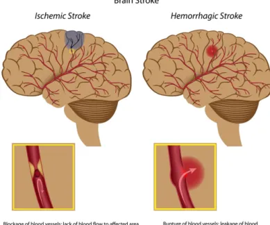 Figure 1.2: Representation of the two main types of stroke: ischemic (left) and hemorragic (right) [12].
