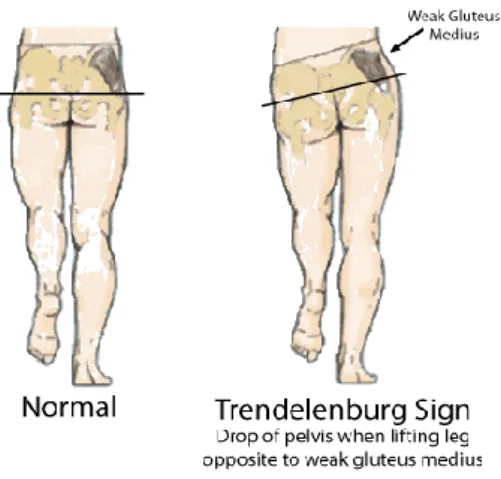 Figure 1.6 - Difference between normal and myopathic gait. Image from [40] 
