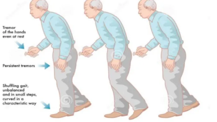 Figure 1.7 - Schematic representation of Parkinsonian gait. image from [21]. 