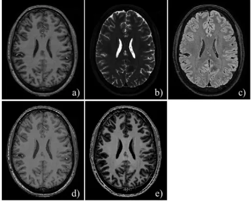 Figure 2.3: MRI scans acquired at 7 T with different contrasts, namely, T1w (a), T2w-TSE (b), FLAIR (c),  MPRAGE (d) and MP2RAGE (e)
