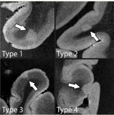 Figure 2.4: The different types of cortical lesions detected with 7 T T2* MRI in a post-mortem study [6]