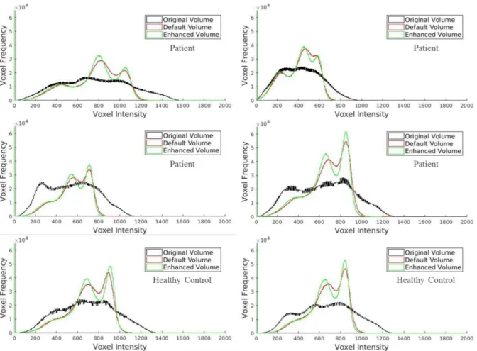 Figure 4.1: Histograms showing the voxel intensity distribution of WM, GM and CSF for a sample of the dataset for the  original and bias corrected volumes using SPM’s default and enhanced parameters