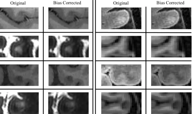 Figure 4.3: Axial cuts displaying cortical lesions before and after bias correction across the patient dataset