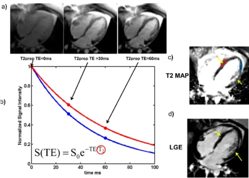 Figure 2.8: Calculation of T2 maps using a T2prep pulse sequence in a patient with atypical Takusubo cardiomyopathy