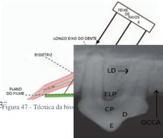 Figura 47 - Técnica da bissetriz (adaptada de Tutt, 2006b)