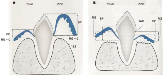 Figura 14: Perda de fixação do dente no alvéolo (adaptado de Gorrel, 2004) 