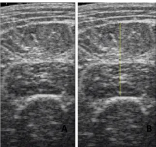 Figura 12 – Imagem dos extensores do joelho (reto femoral + Vasto intermédio) no aparelho  de ultrassonografia