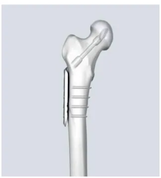 Figura 2 – Representação do material osteossintético utilizado no procedimento DHS. 