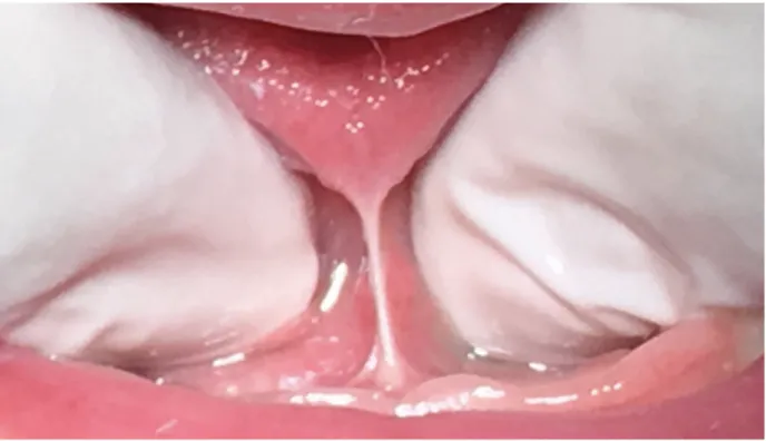 Figura 5 – Frênulo lingual inserido no ápice da língua e face interna da crista alveolar  Fonte: autoria própria 