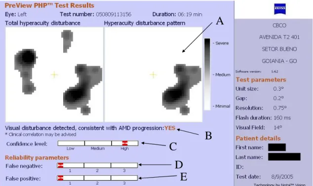 Figura  10  –  Resultado  de  teste  do  PHP  do  olho  esquerdo  de  paciente  do  grupo  DMRI  neovascular  (DFA,  70  anos,  sexo  feminino)