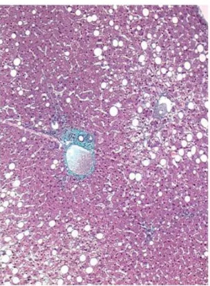 Figura  2  –  Peça  histológica  hepática  mostrando  a  presença  de  esteatose  moderada  na  região centrolobular
