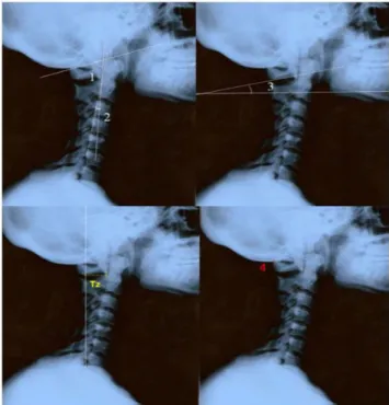 Figura  5  -  Diagrama  ilustrativo  dos  parâmetros  radiográficos  utilizados:  1,  ângulo  cervical  superior;  2,  ângulo  cervical  inferior;  3,  ângulo  do  plano  do  atlas;  Tz  (C2/C7),  distância  de  translação anterior; 4, distância altas-occi