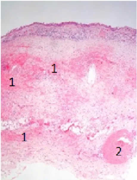 Figura 13: Microscopia com coloração hematoxilina/eosina dos retalhos  da cápsula do quisto broncogénico, onde se observa a parede do quisto  com hemorragia (1) e congestão (2), revestida por epitélio respiratório