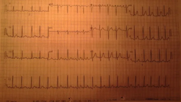 Figura 16: ECG com fibrilhoflutter e  FC de cerca de 114 bpm. 