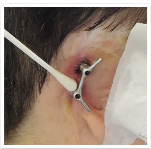 Figura 07 – Segundo momento de coleta de material em pele perimplantar de Implante  Inferior no paciente do Caso 01
