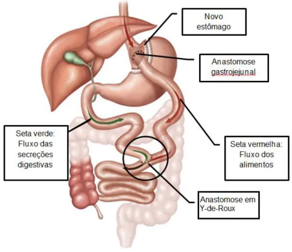 Figura 1 – Ilustração esquemática da gastroplastia redutora com derivação gastro jejunal em  Y-de-Roux (Sociedade Brasileira de Cirurgia Bariátrica, 2012)