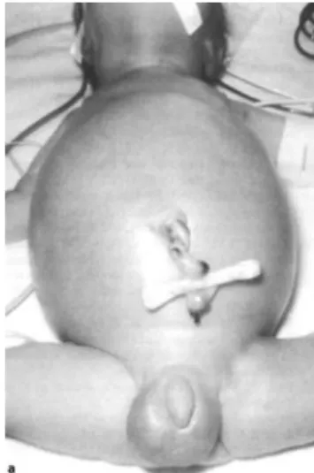 Fig 2. Distensão abdominal em lactente com DH. 5