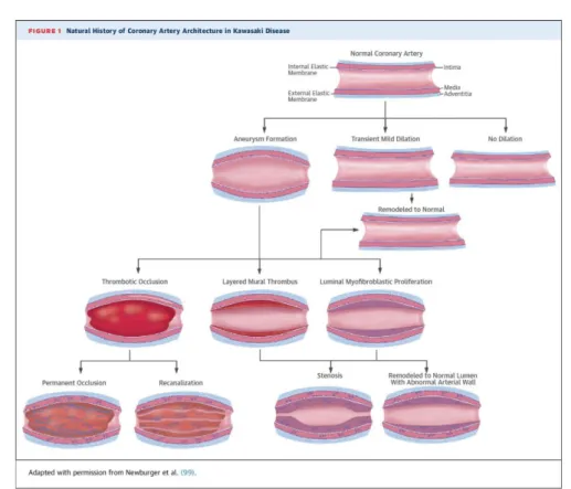 Figura 1 - História natural das artérias coronárias na Doença de Kawasaki. 