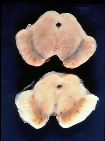Fig. 1  Pigmentação normal dos neurónios dopaminérgicos da substância negra numa   pessoa saudável (cima); Despigmentação dos neurónios dopaminérgicos da substância  