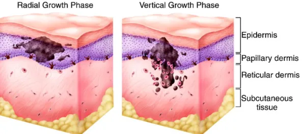 Figure 3: Radial and vertical growth phase during Melanoma progression. (Adapted from Hodi F