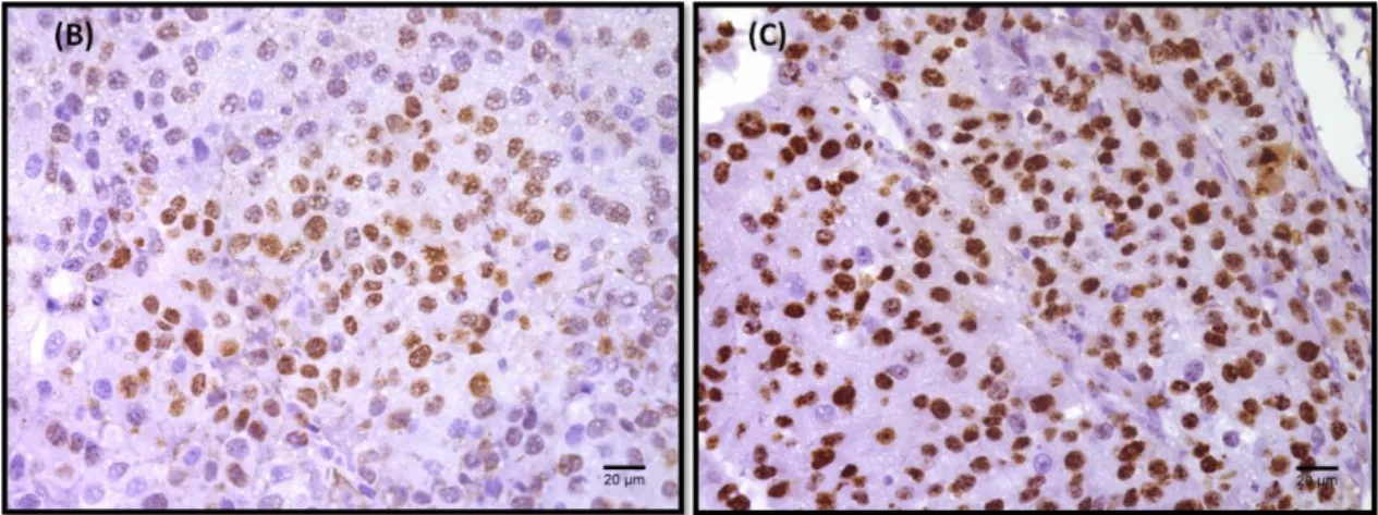 Figure 6: Quantification of tumor cell proliferation by Ki67 in Melanoma tumors. Tumor sections from WT and LDLR KO mice was  stained  for Ki67 (proliferation marker) to see in vivo proliferation