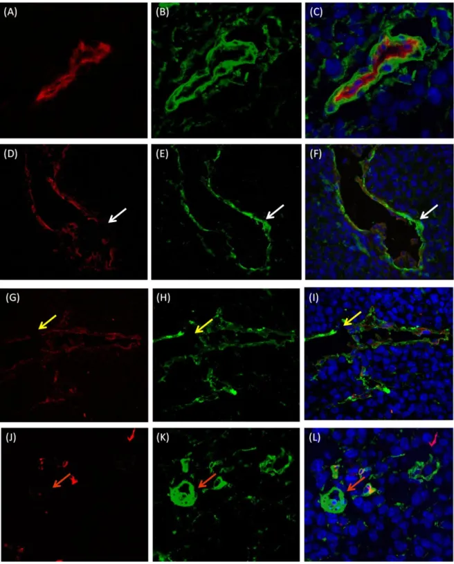 Figure 10:  Different  Patterns of Tumor Blood Supply in Melanoma. Total number of vessels were counted  in 10 high-powered  fields  (40x  magnification)  of  one  tumor  section  stained  for  both  following  markers:  CD31  (endothelial  marker)  and  L