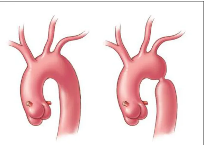 Figure 1: Normal aortic arch (left) and aortic arch with CoAo (right). 