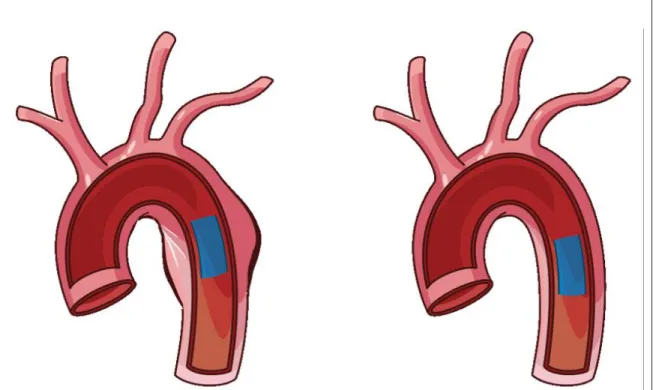 Figure 4: Difference of blood flow velocity in compliant (left) and stiff (right) arteries
